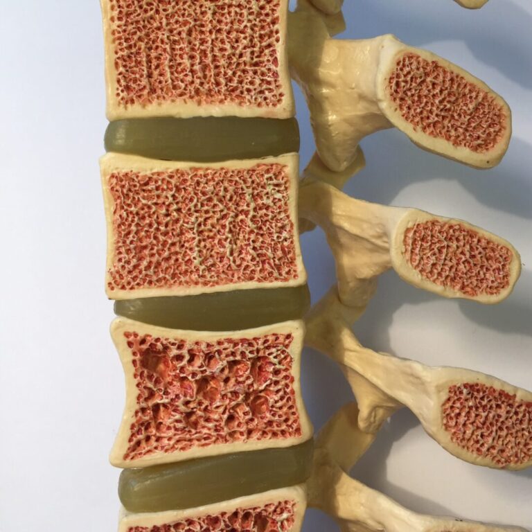 #11: Mejora la Osteoporosis con Ejercicio